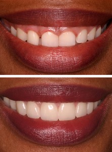 Crown Lengthening